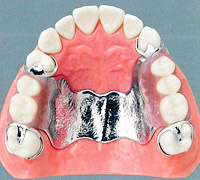 金属床義歯【自費診療】