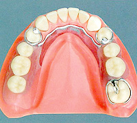 金属床義歯【自費診療】