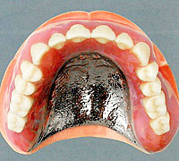 金属床義歯【自費診療】