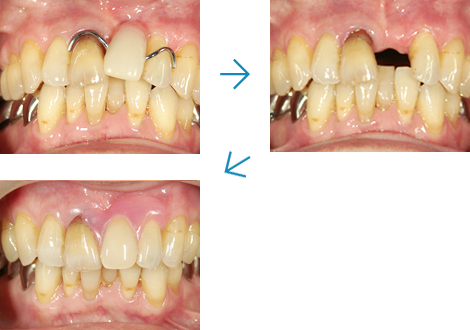 留め金のない入れ歯（義歯）の例～当医院での義歯症例～
