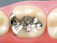 そのままでいいの？銀歯の持つデメリット