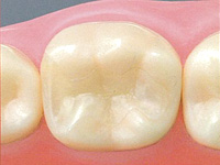 セラミックインレー（E-MAX）【自費診療】