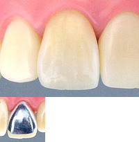 硬質レジン前装冠【保険診療】