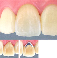 セラミッククラウン（ジャケット）【自費診療】