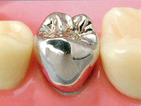 メタルクラウン【保険診療】