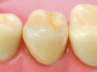 セラミク・ジルコニアクラウン【自費診療】