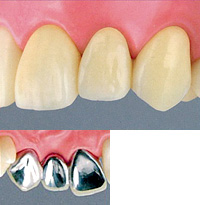 硬質レジンブリッジ【保険診療】