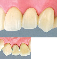 メタルボンド・ジルコニアブリッジ【自費診療】