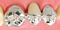 金銀パラジウム合金ブリッジ【保険診療】