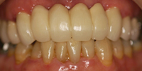前歯部審美修復のケース