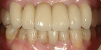 前歯部審美修復のケース
