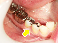 セラミック治療のケース