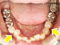 セラミック治療のケース