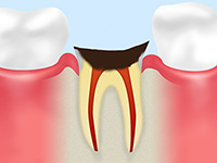 C4　歯の根に達した虫歯