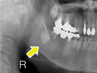 難易度の高い親知らずの抜歯の症例