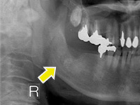 難易度の高い親知らずの抜歯の症例