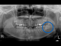 左下の親知らずが、水平に埋まっています。