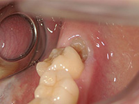 左下の親知らずが、水平に埋まっています。