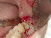 歯ぐきを切開し、親知らずの一部を削りました。