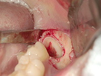 歯ぐきを切開し、親知らずの一部を削りました。