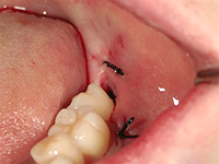 歯ぐきを戻し、縫合しました。右は削りだした親知らずです。