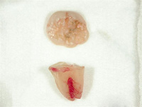 歯ぐきを戻し、縫合しました。右は削りだした親知らずです。