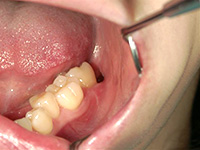 術後2週間すると、傷がきれいに回復しています。