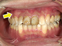 膿胞（のうほう）摘出