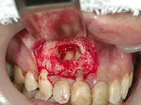 膿胞（のうほう）摘出