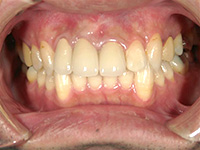 膿胞（のうほう）摘出