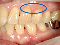 結合組織移植術