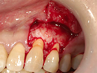 結合組織移植術