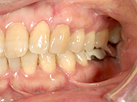 結合組織移植術