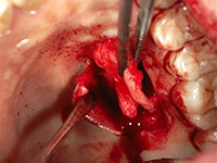 結合組織移植術