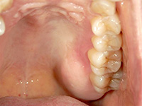 結合組織移植術